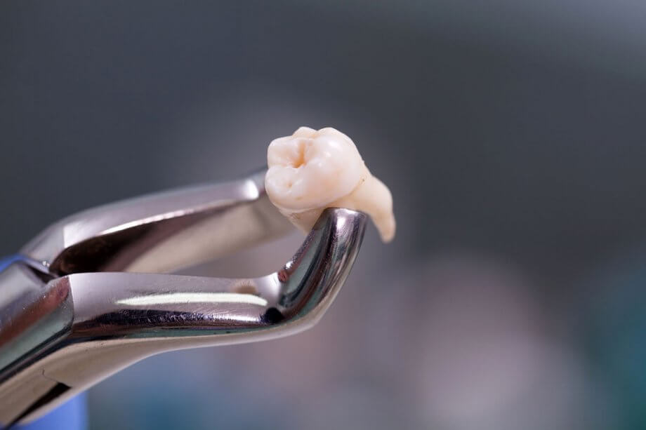wisdom teeth removal aspendale